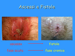 FISTOLA PERIANALE